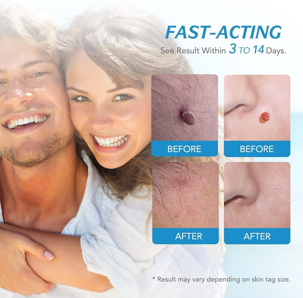 2 in 1 Skin Tag Remover Kit - Painless m2wvuk-pc