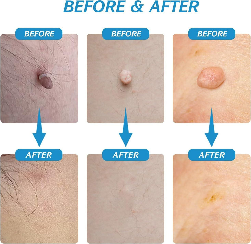 2 in 1 Skin Tag Remover Kit - Painless m2wvuk-pc